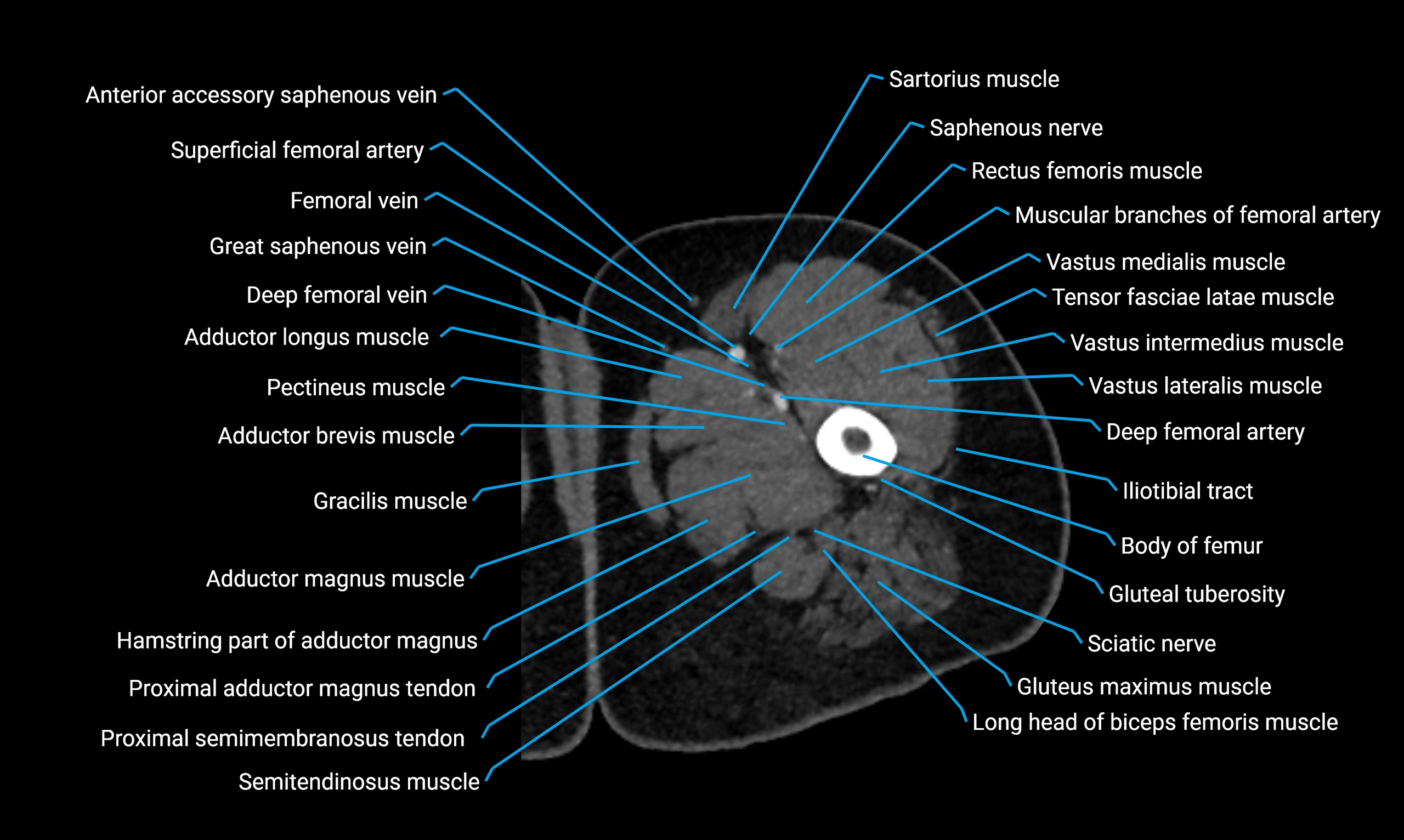 CT thigh axial cross sectional anatomy labelled image_26 (3).webp